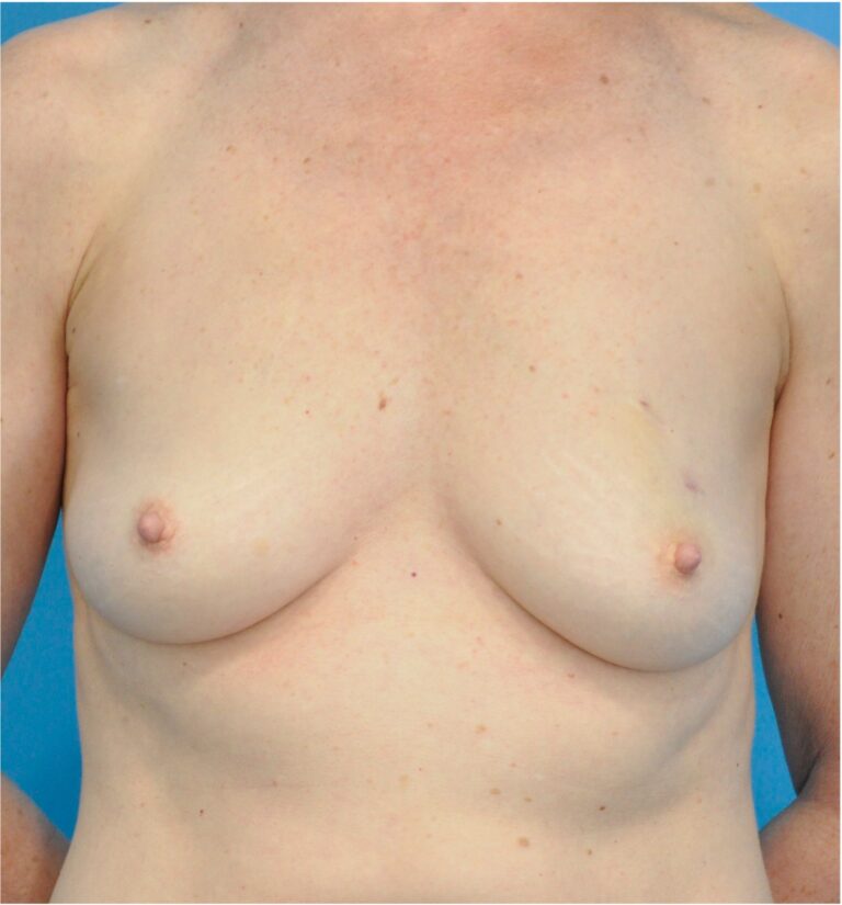 Breast Augmentation before and after - before