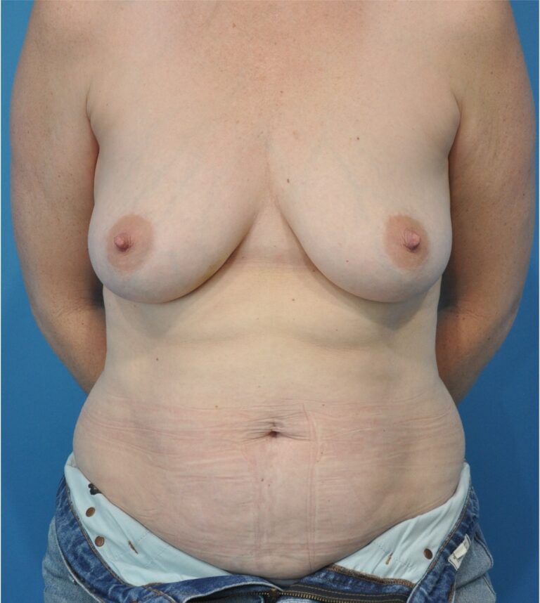 Procedure before and after - before
