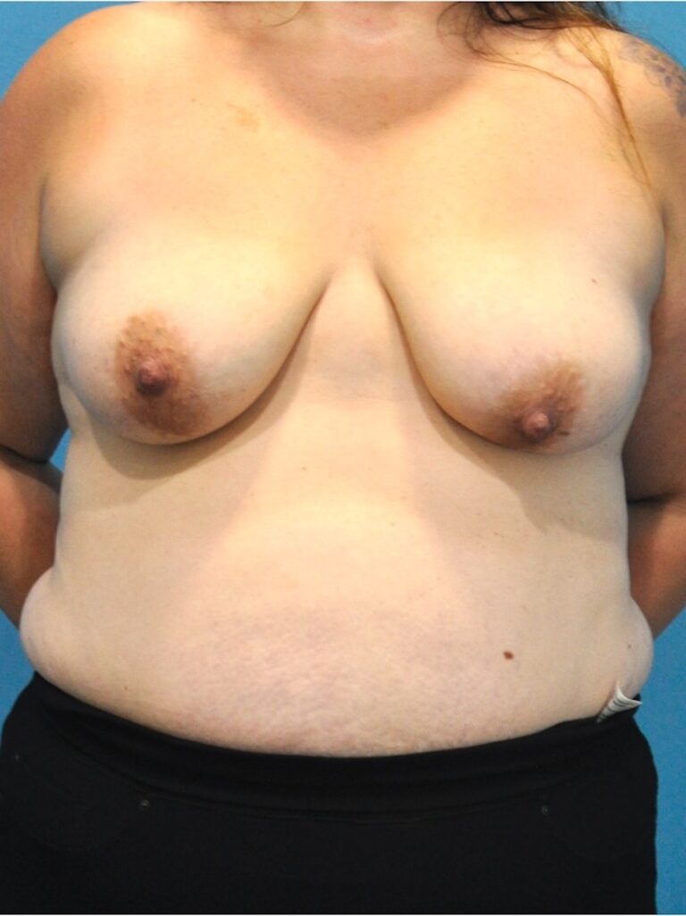 Mommy Makeover before and after - before