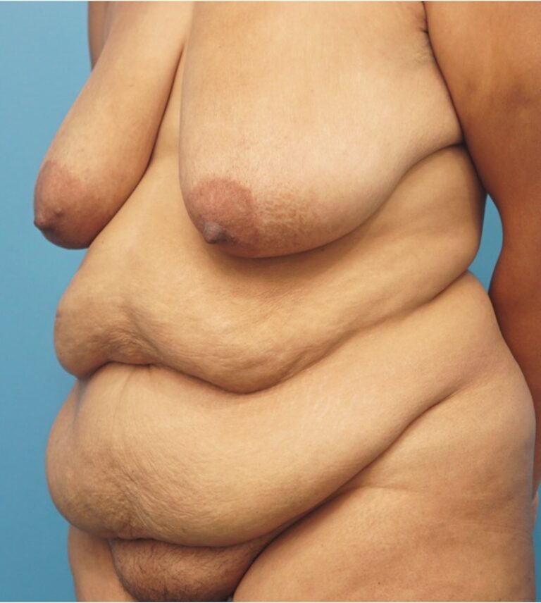 Tummy Tuck before and after - before