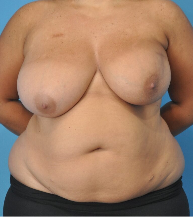 Procedure before and after - before