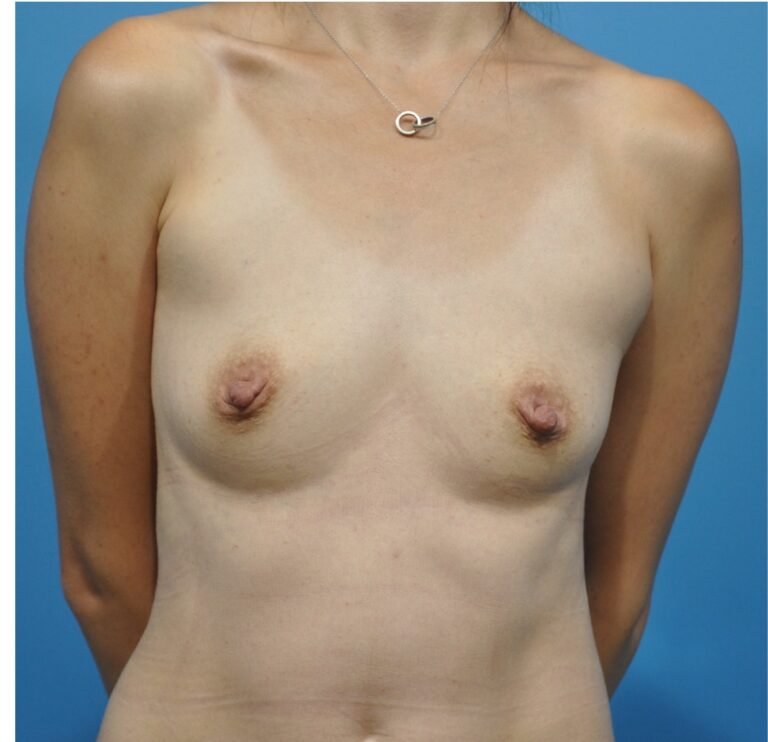 Breast Augmentation before and after - before