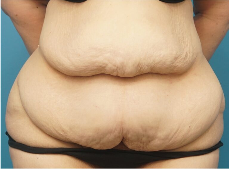 Tummy Tuck before and after - before