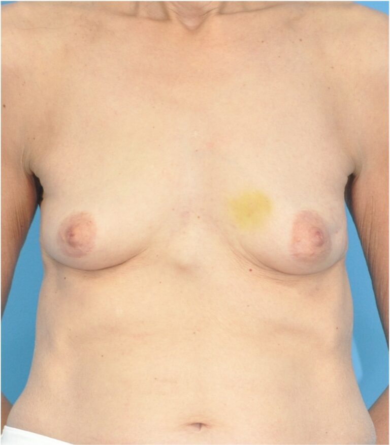 Procedure before and after - before