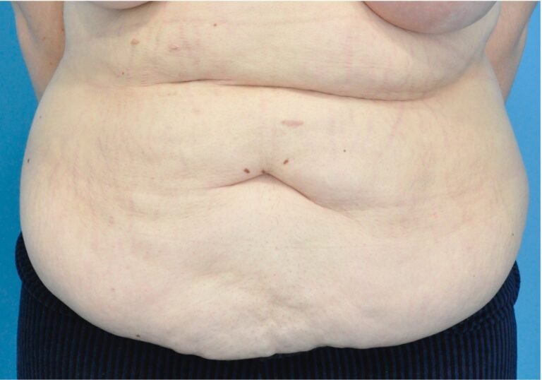 Tummy Tuck before and after - before