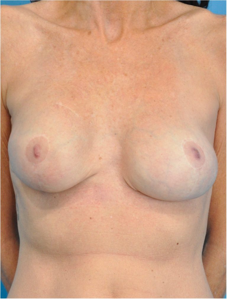 Breast Augmentation before and after - before