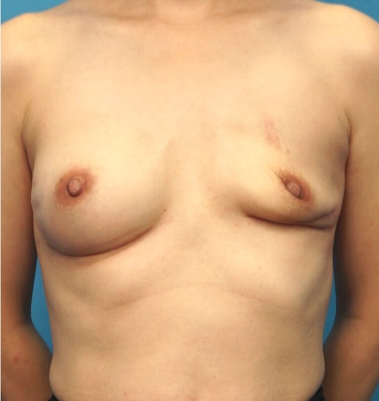 Procedure before and after - before