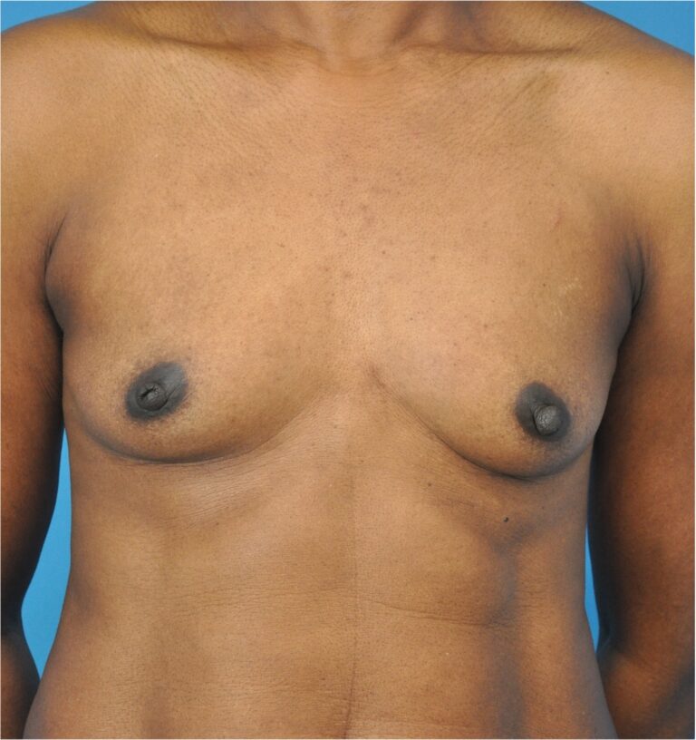 Breast Augmentation before and after - before