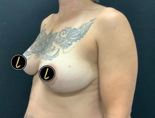 Breast Reduction before and after - after