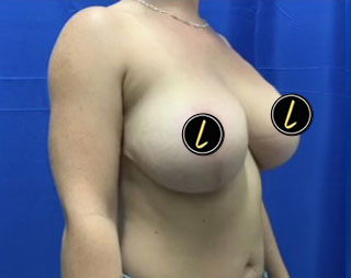 Breast Lift before and after - after