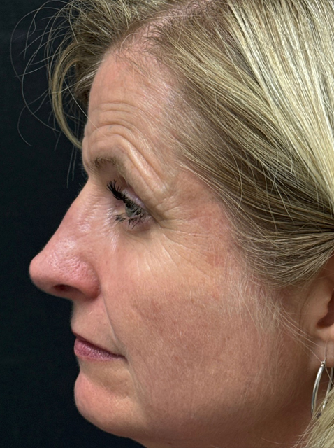 Rhinoplasty before and after - after