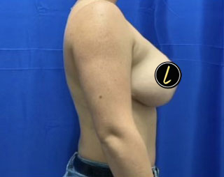 Breast Lift before and after - after