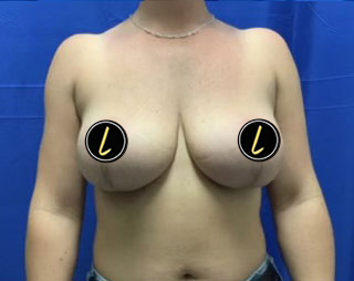Breast Lift before and after - after