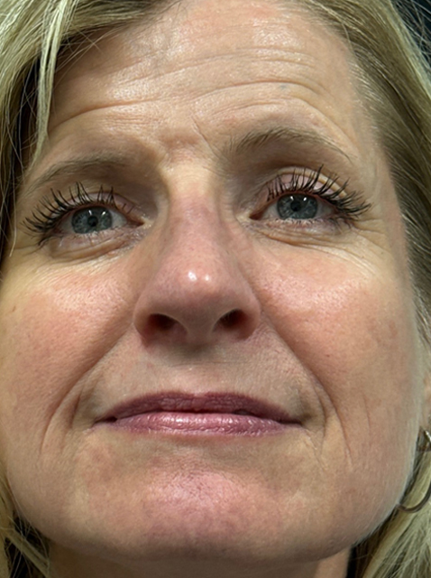 Rhinoplasty before and after - after