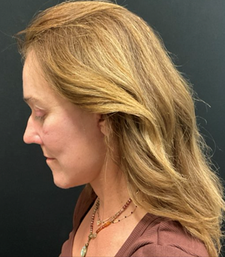 Facelift before and after - after