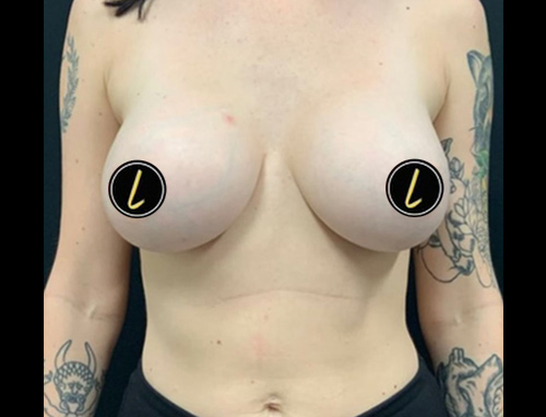 Breast Augmentation before and after - after