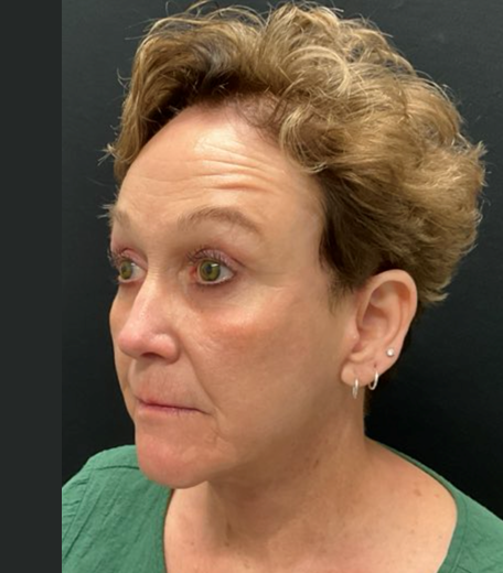 Facelift before and after - after