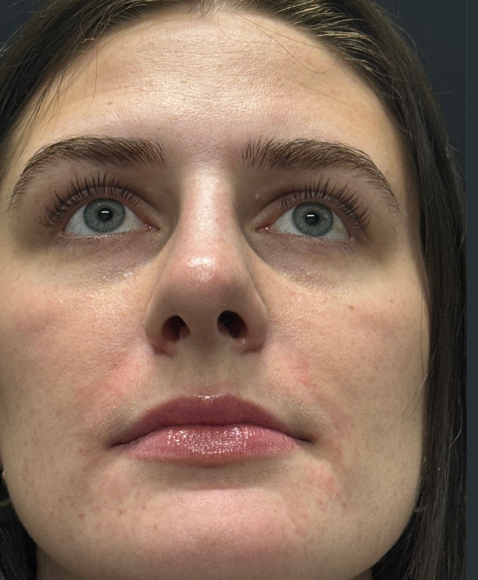 Rhinoplasty before and after - after