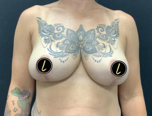 Breast Reduction before and after - after
