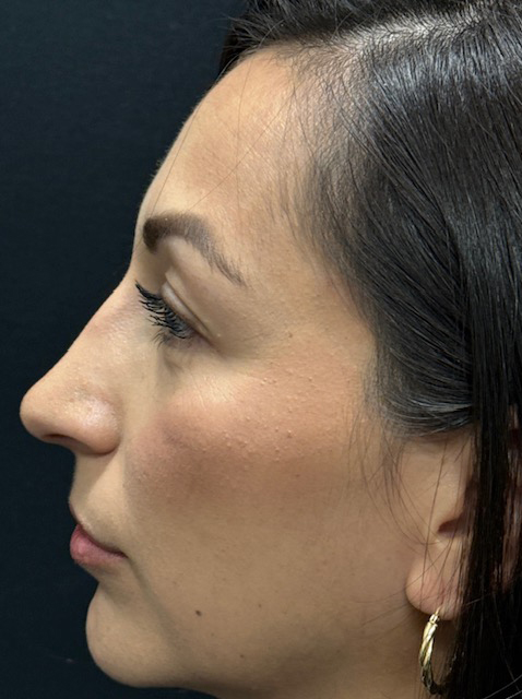 Rhinoplasty before and after - after