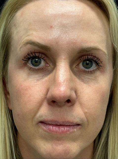 Rhinoplasty before and after - after
