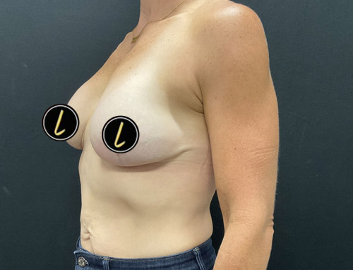 Breast Revision before and after - after