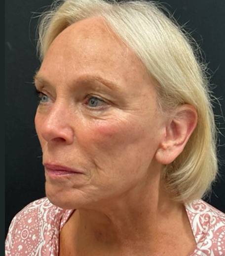 Facelift before and after - after