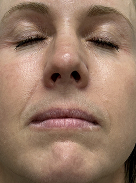 Rhinoplasty before and after - after