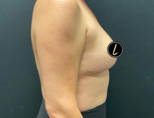 Breast Reduction before and after - after
