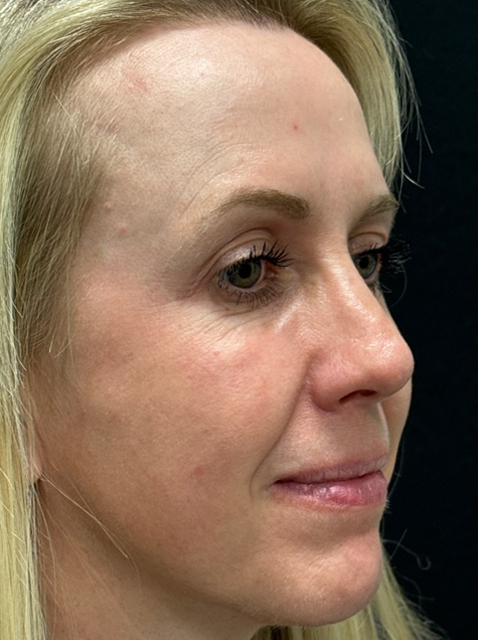 Rhinoplasty before and after - after