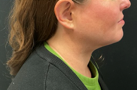 Facelift before and after - after