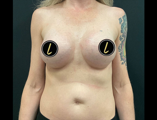 Breast Augmentation before and after - after