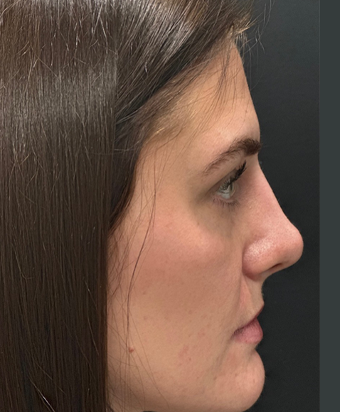 Rhinoplasty before and after - after