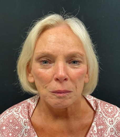 Facelift before and after - after