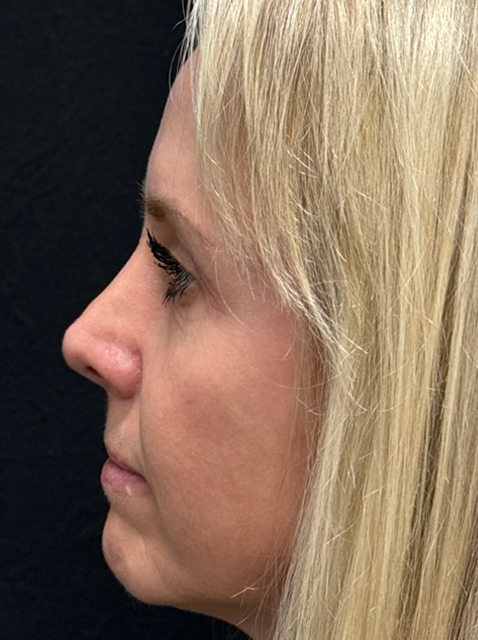 Rhinoplasty before and after - after