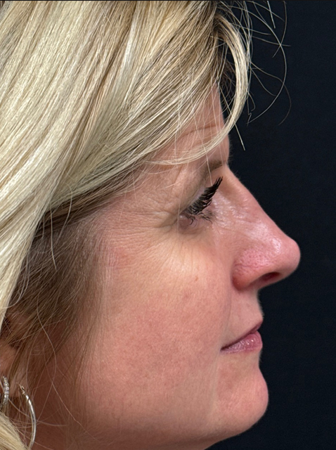 Rhinoplasty before and after - after