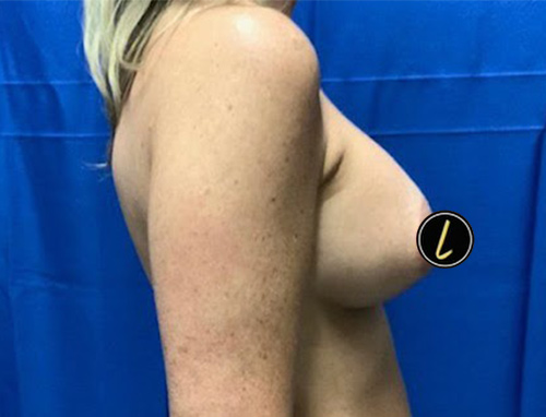 Breast Augmentation before and after - after