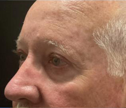 Male Blepharoplasty before and after - after
