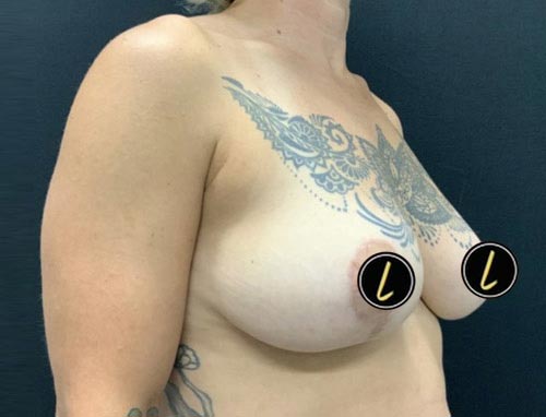 Breast Reduction before and after - after