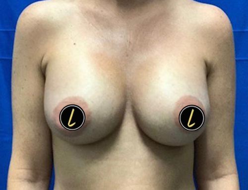 Breast Augmentation before and after - after