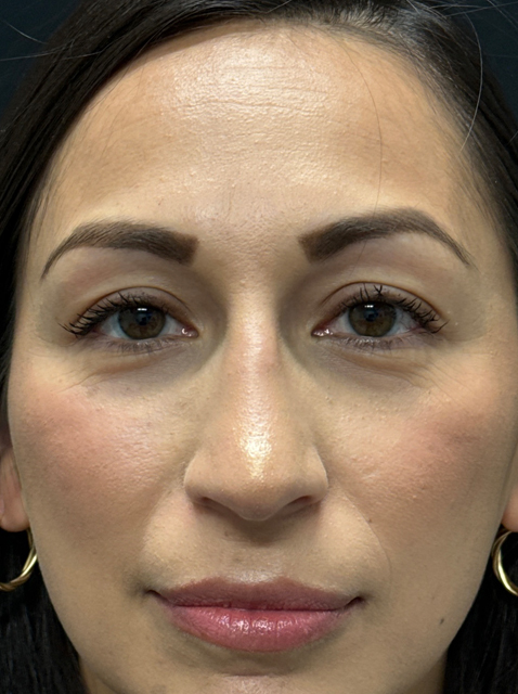 Rhinoplasty before and after - after