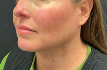 Facelift before and after - after