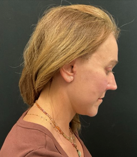 Facelift before and after - after