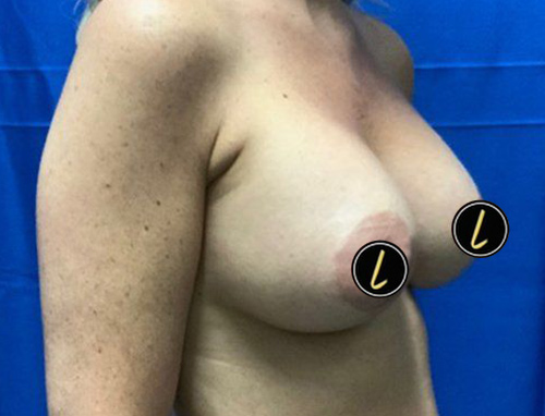 Breast Augmentation before and after - after