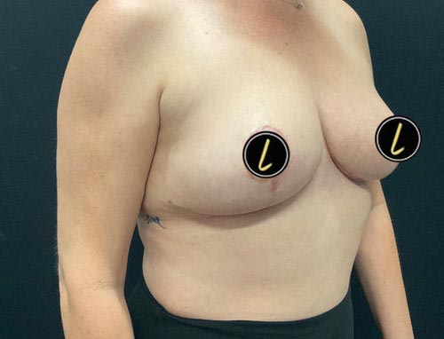 Breast Reduction before and after - after