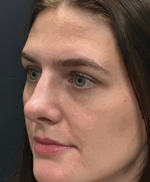 Rhinoplasty before and after - after