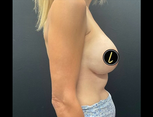 Breast Augmentation before and after - after