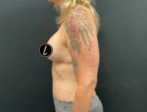 Mommy Makeover before and after - after