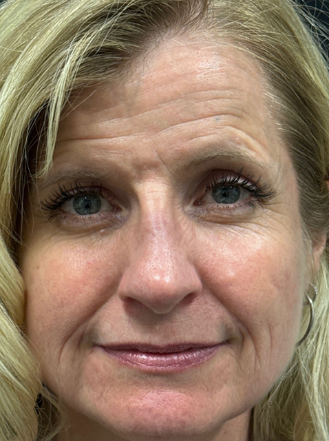 Rhinoplasty before and after - after