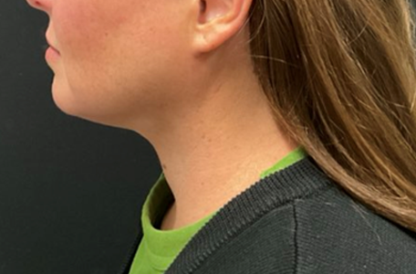 Facelift before and after - after